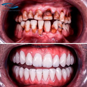 Implantes resultados (2)