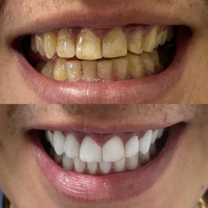 Facetas-3.webp