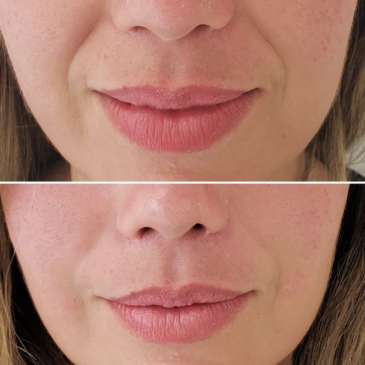 Bigode Chinês: O Que Causa Essa Marca Profunda e Como Rejuvenescer o Rosto Sem Perder Sua Essência