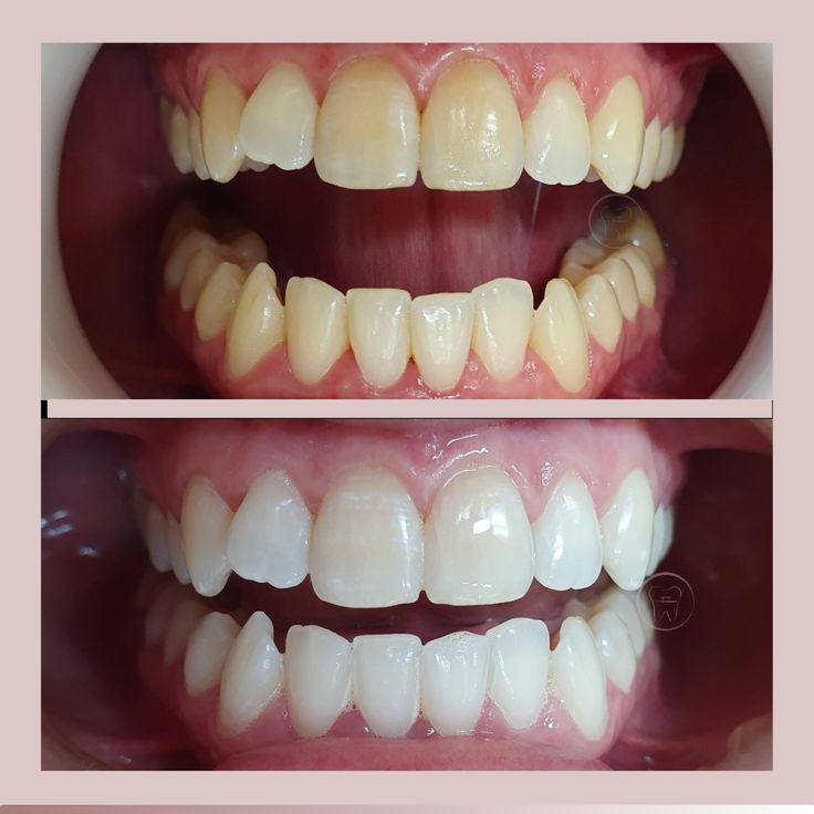 Clareamento Dental: Realce Seu Sorriso com Segurança, Eficiência e Rapidez