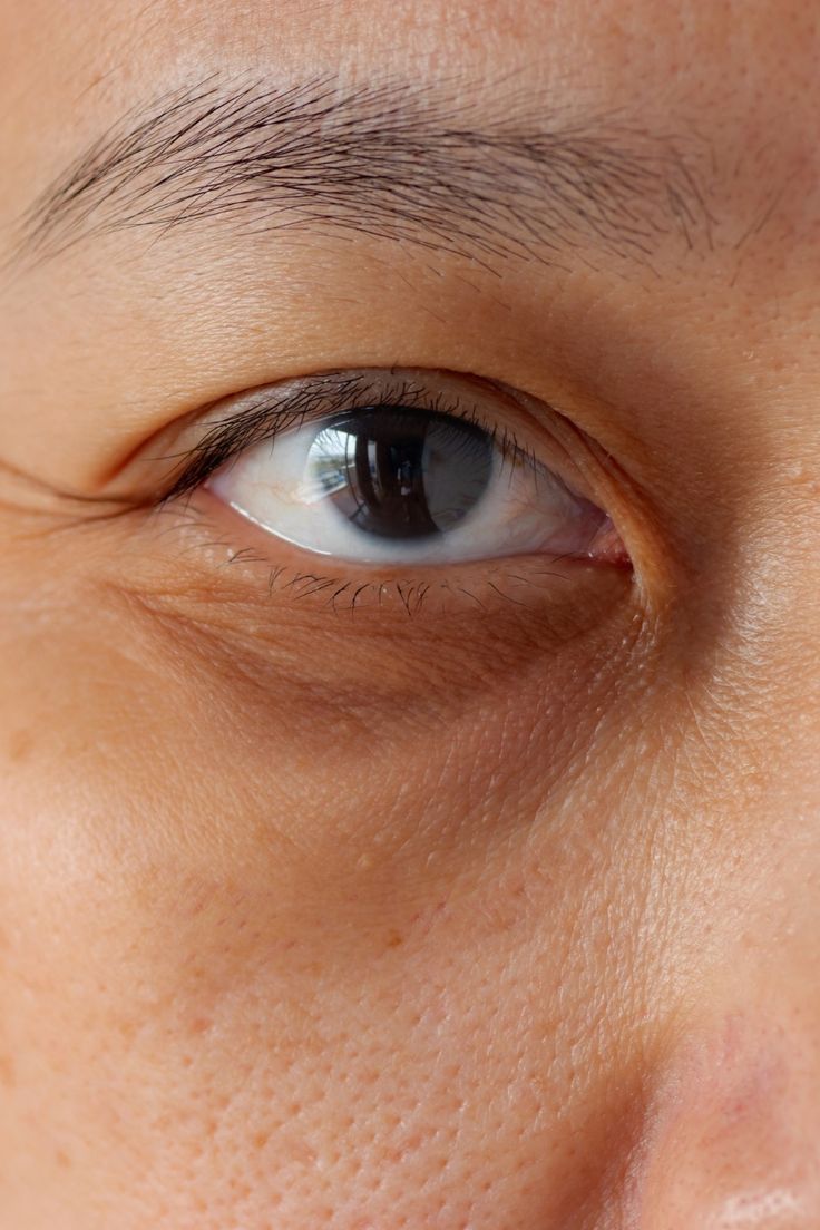 Olheiras Profundas: Estética ou Sinal de Desequilíbrio Interno?