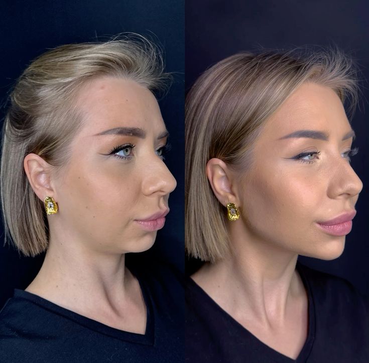 Como Potencializar Sua Harmonização Facial com Suplementos Anti-inflamatórios?