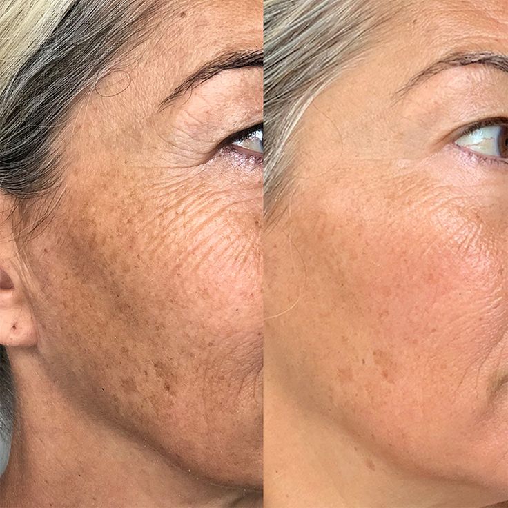 Peeling e Suplementação: Por Que Essa Combinação Traz Resultados Surpreendentes?