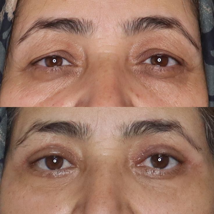 Preenchimento Facial: Beleza Natural com Segurança e Cuidados Internos