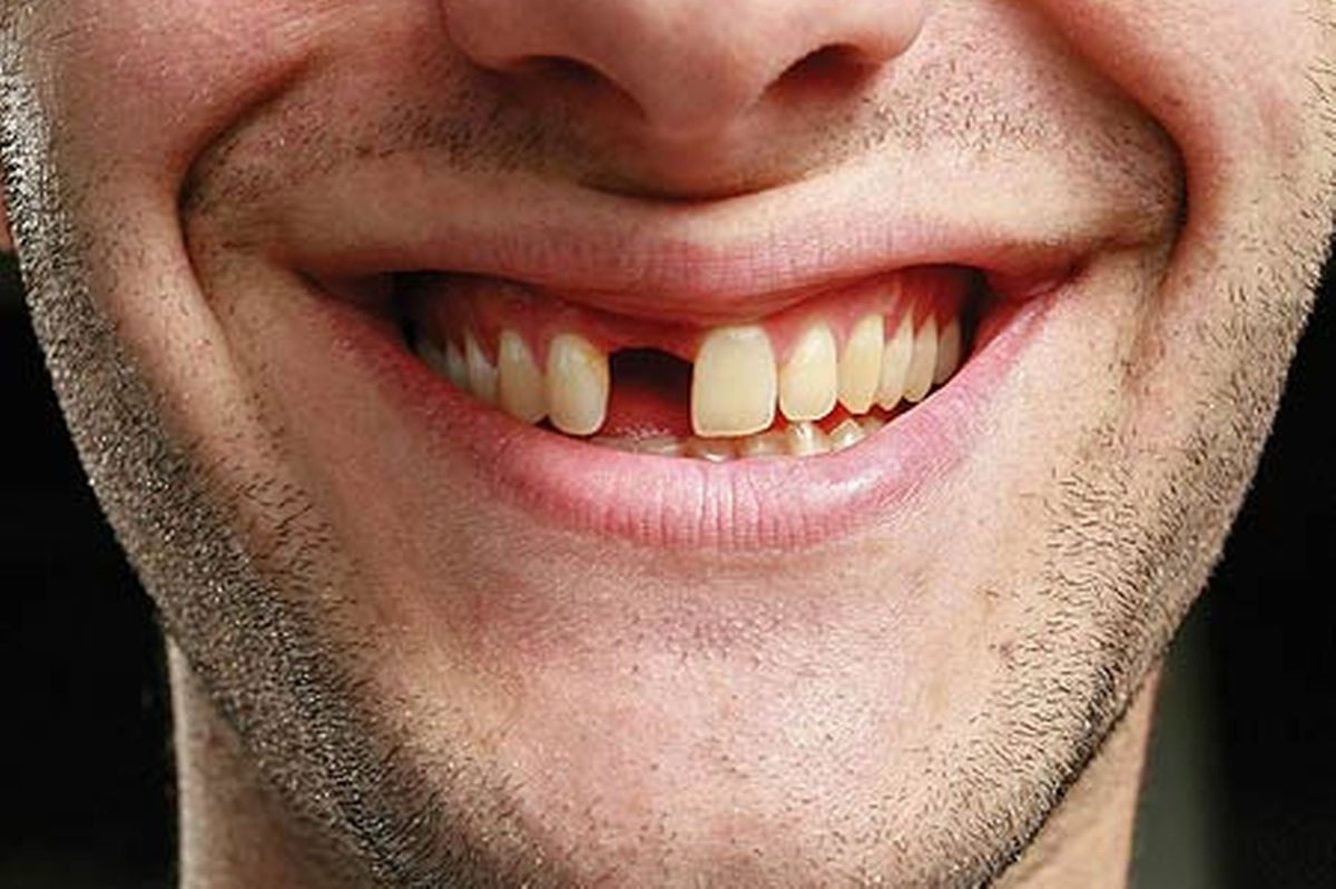 Perdi um dente: qual a melhor solução?