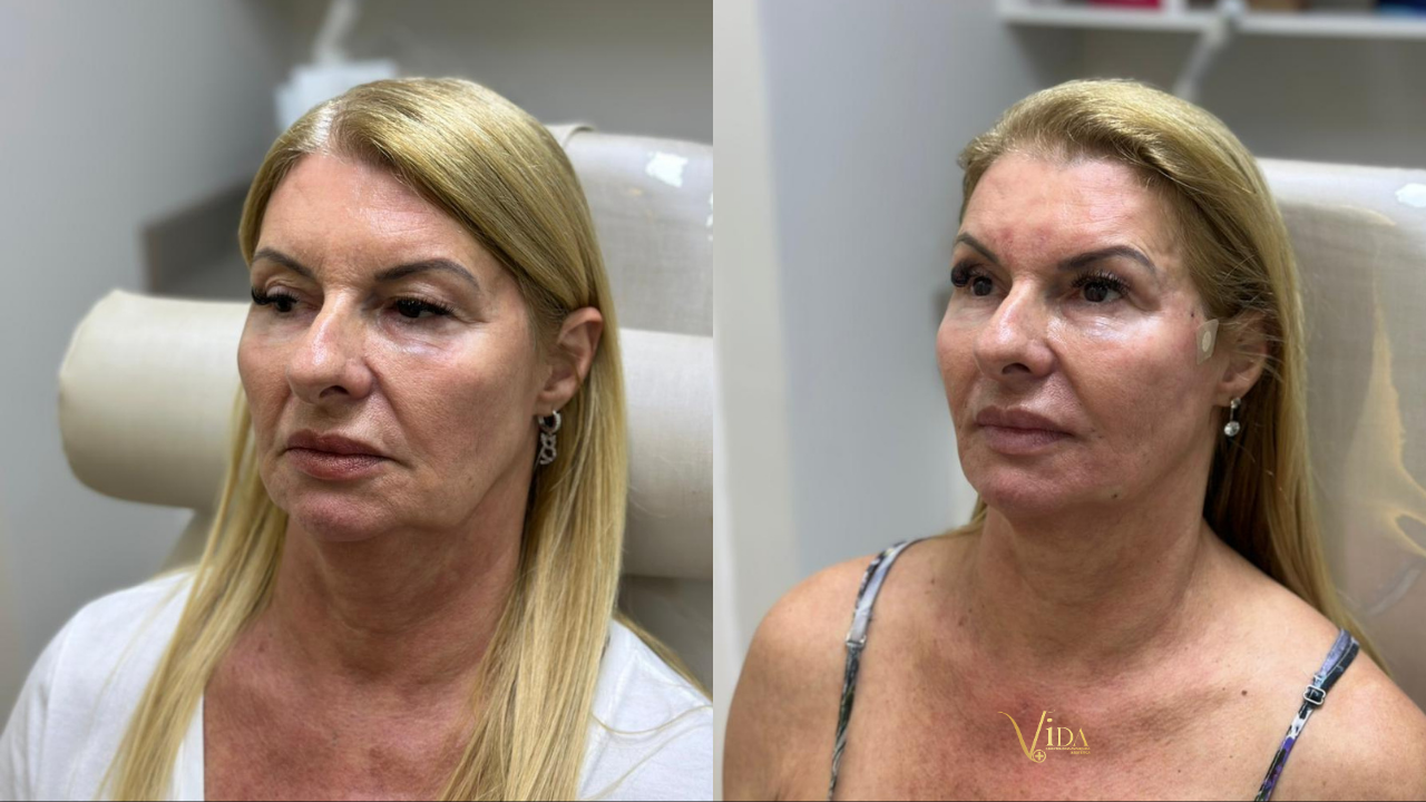 Harmonização Full Face: o segredo por trás de um rosto mais jovem, natural e equilibrado