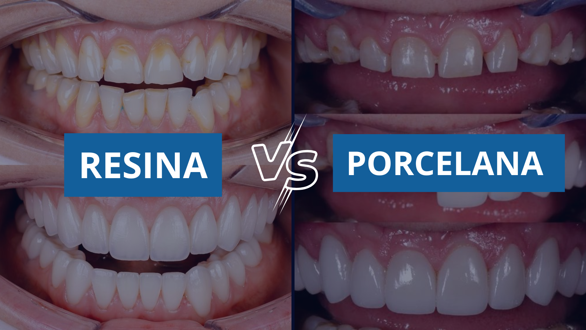 FACETA EM RESINA OU PORCELANA: QUAL REALMENTE VALE A PENA?