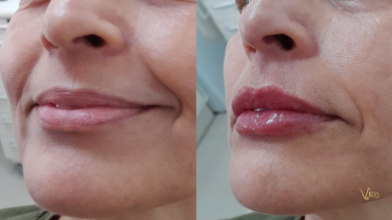 Preenchimento labial: o que realmente define um resultado bonito?