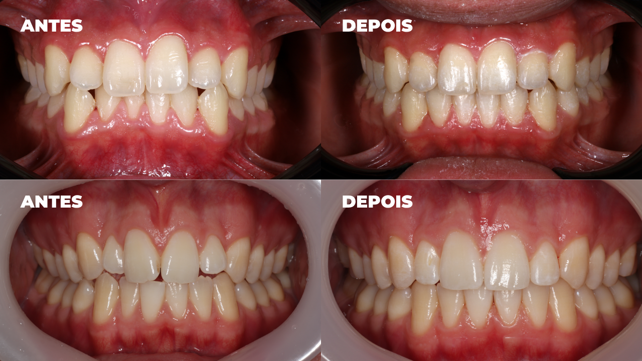 Alinhador invisível vale a pena?