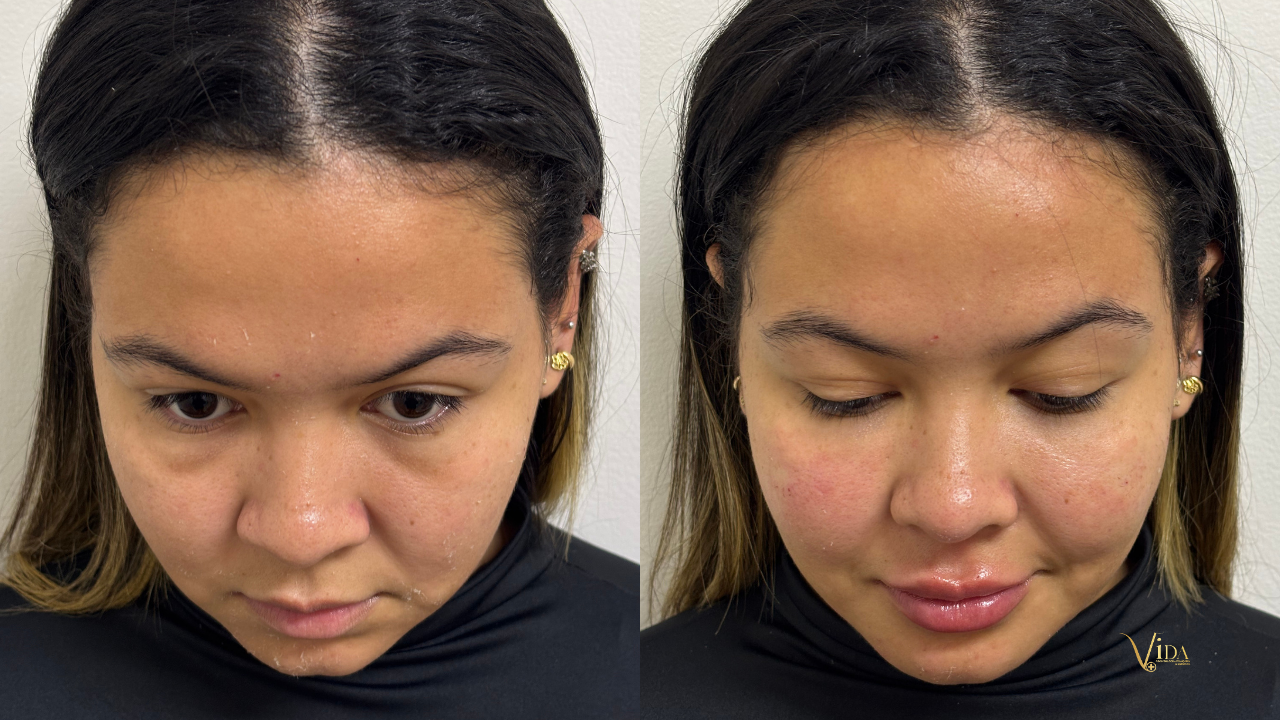 Preenchimento de olheiras: o que realmente está por trás do seu olhar cansado?