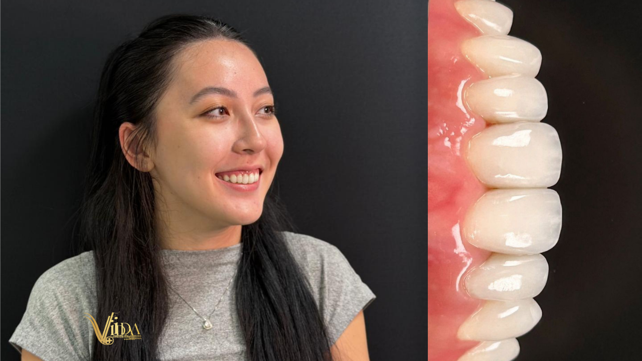 O que são facetas dentárias?