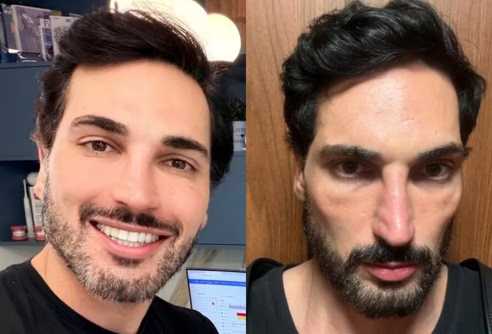 Perda de gordura facial após o Mounjaro: por que isso acontece?