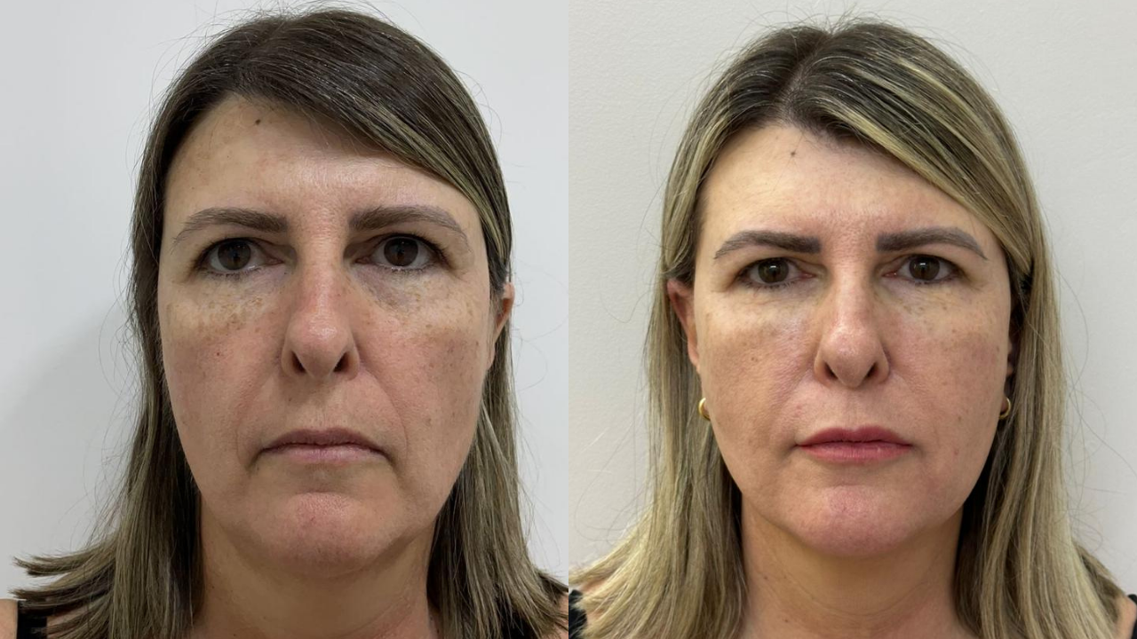Linhas de marionete: por que elas deixam o rosto com aparência triste e cansada?