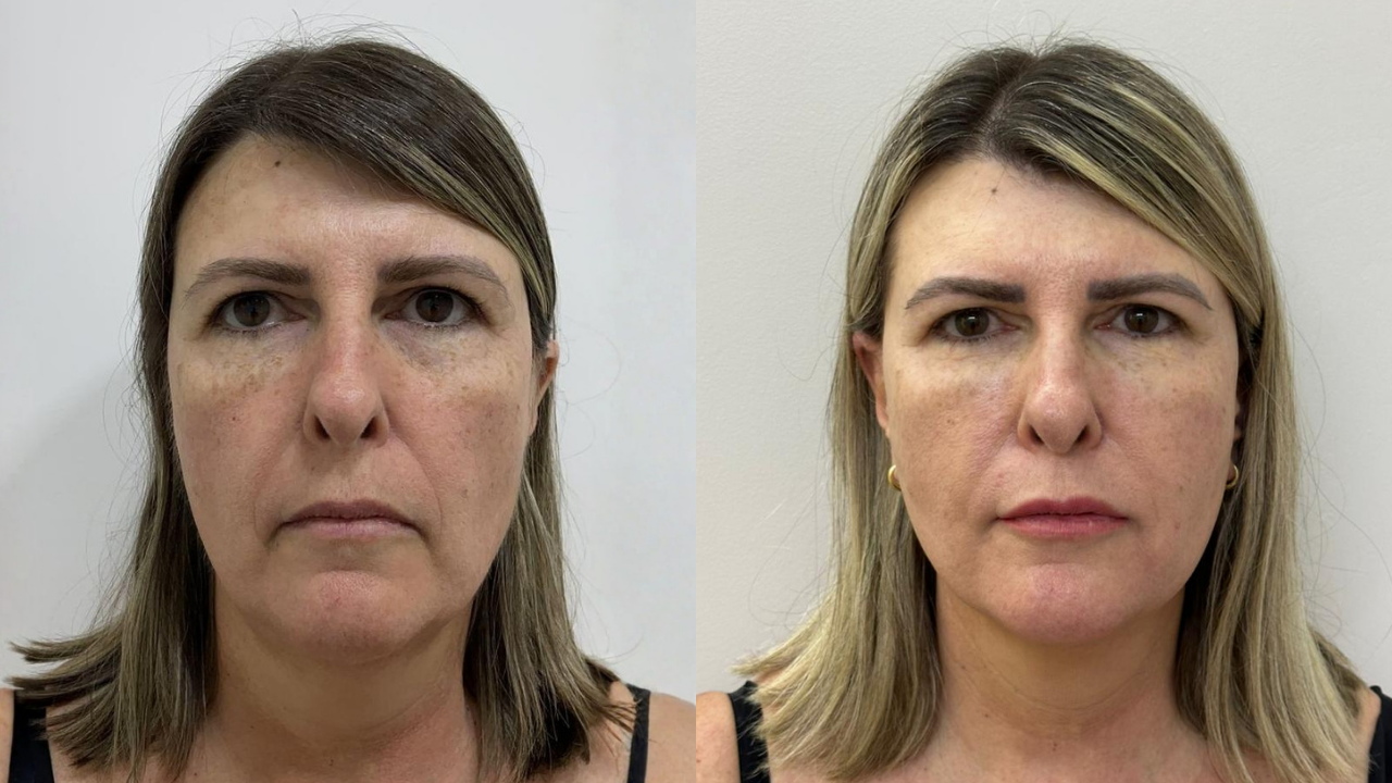 Como rejuvenescer o rosto sem perder sua identidade?