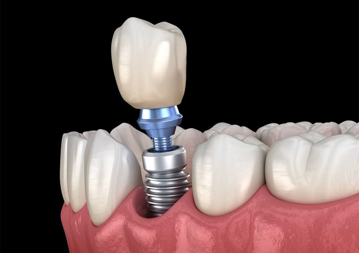 COMO SABER SE SOU UM BOM CANDIDATO PARA IMPLANTES DENTÁRIOS?
