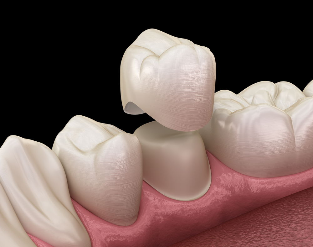 FACETAS OU COROAS: QUAL A MELHOR ESCOLHA PARA RECUPERAR A ESTÉTICA DO SORRISO?