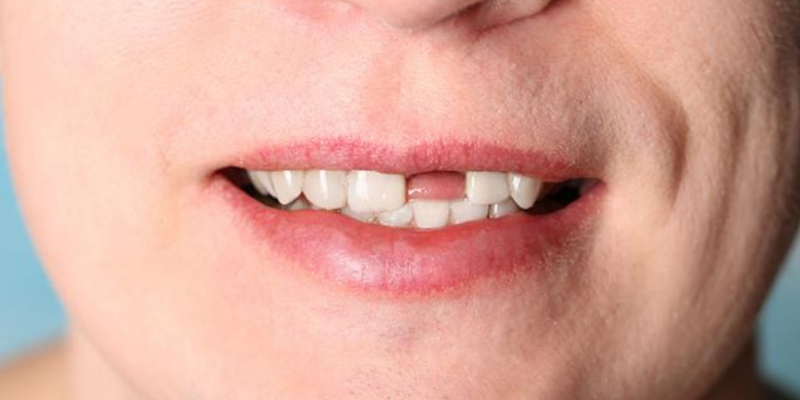 PERDI UM DENTE: O QUE ACONTECE SE EU DEMORAR PARA FAZER O IMPLANTE?