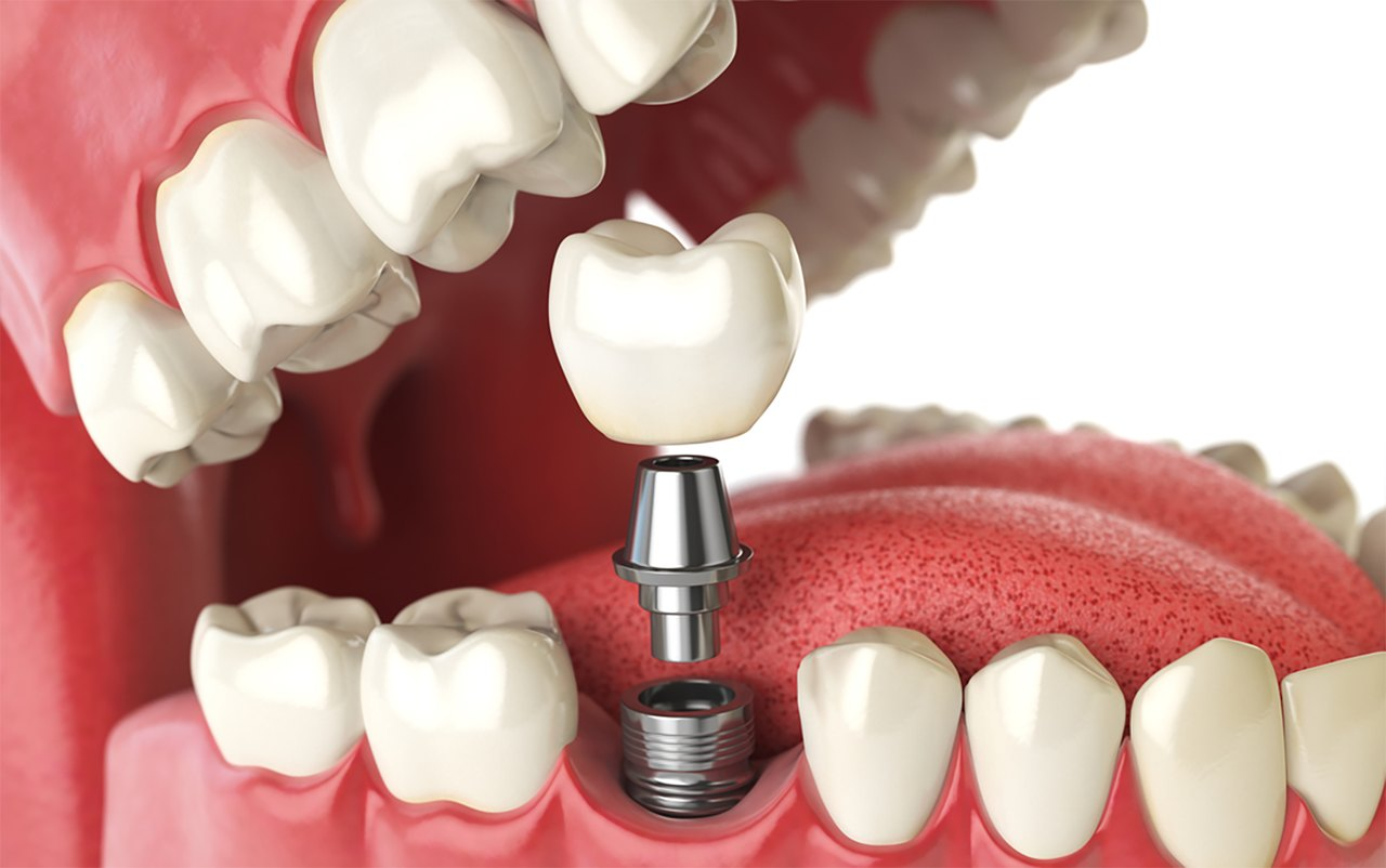 Implante dentário: quanto tempo demora para colocar um dente novo?