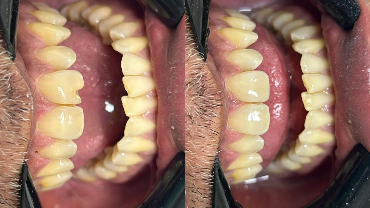 Sorriso desgastado, quebrado ou incompleto: quais tratamentos devolvem função e estética? 
