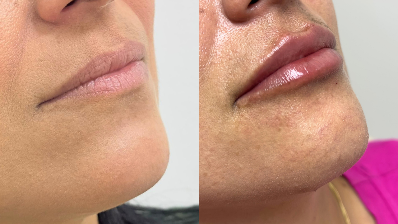 Preenchimento Labial: como valorizar os lábios com naturalidade e harmonia?