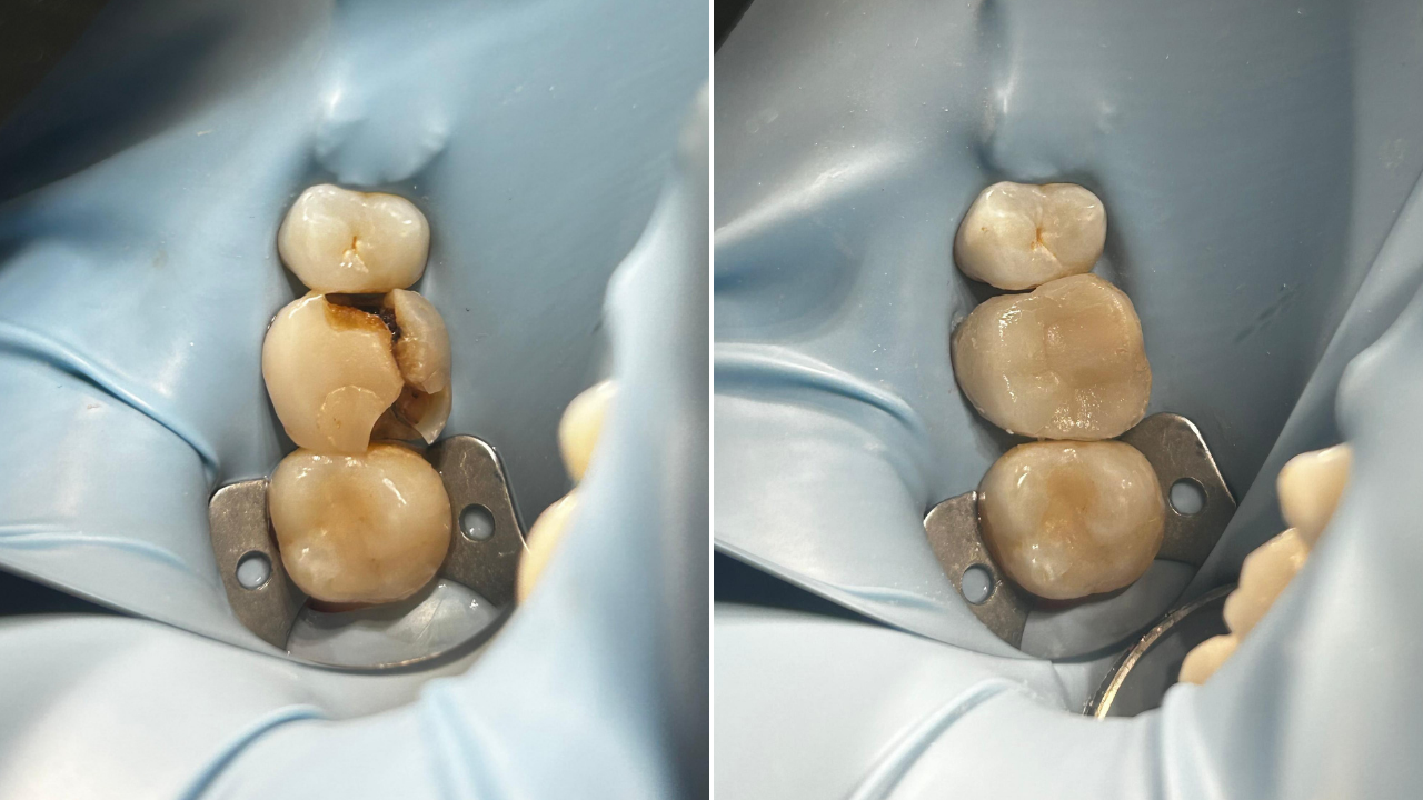 Dente quebrado: quando é possível restaurar e quando é preciso colocar uma prótese?